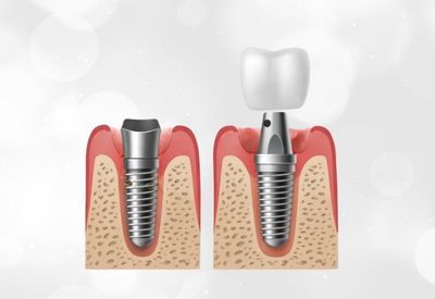 kronen und brücken kronen und brücken