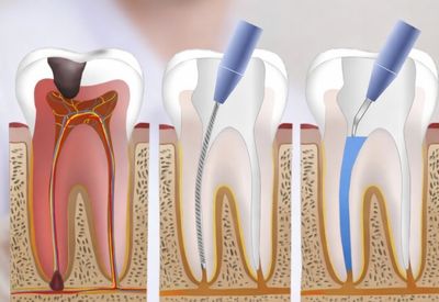 endodontologie fallanden